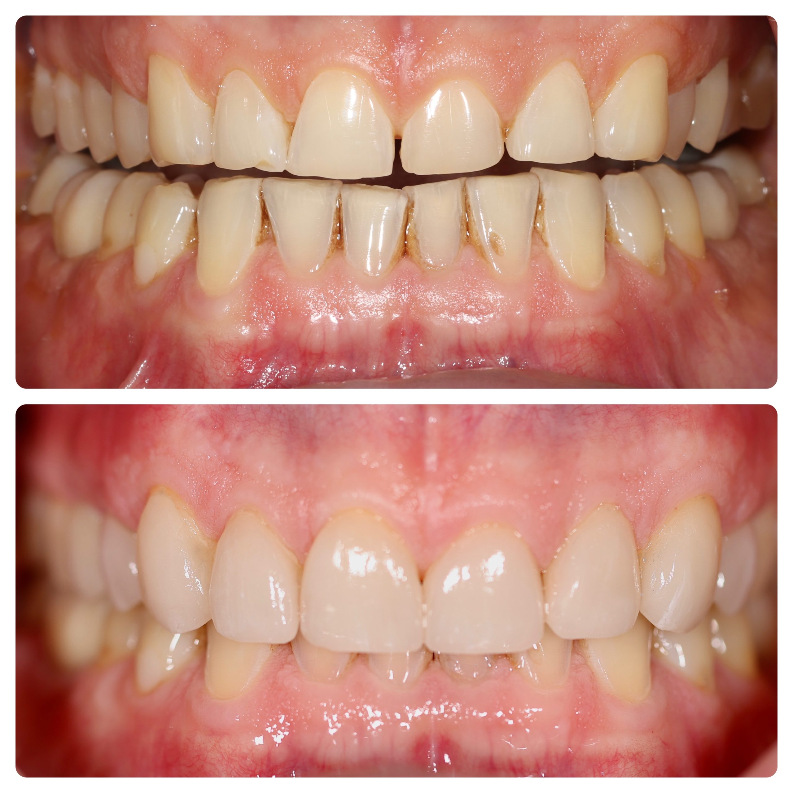 Smile Makeovers Invisalign Veneer Results Vernon Dental Arts Gallery